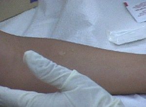 PPD skin test screening set for Jose Rios Middle School community