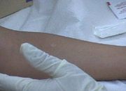 PPD skin test screening set for Jose Rios Middle School community