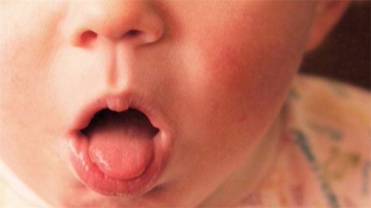 Whooping cough cases rise
